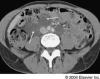 renal angiomyolipoma / #235799