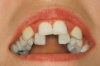 düzgün diş vs beyaz diş